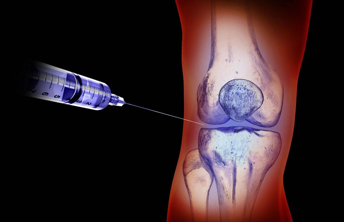 alluran intra-articular don arthrosis