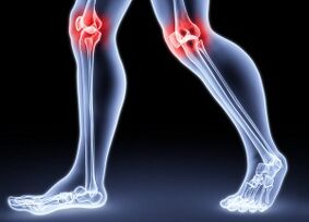 Dalilan Dalilin Ci gaban gwiwa Arthrosis