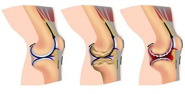 Matakai na ci gaba na arthrosis na gwiwa hadin gwiwa
