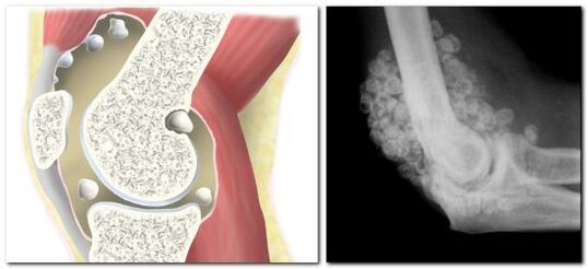 chondromatosis tare da ciwo a cikin haɗin gwiwa na hip