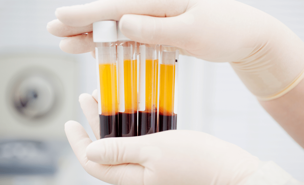Platelet mai arzikin plasma don maganin PRP don arthrosis