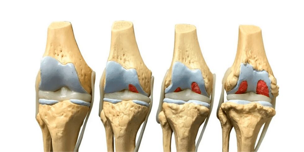 digiri na arthrosis na gidajen abinci